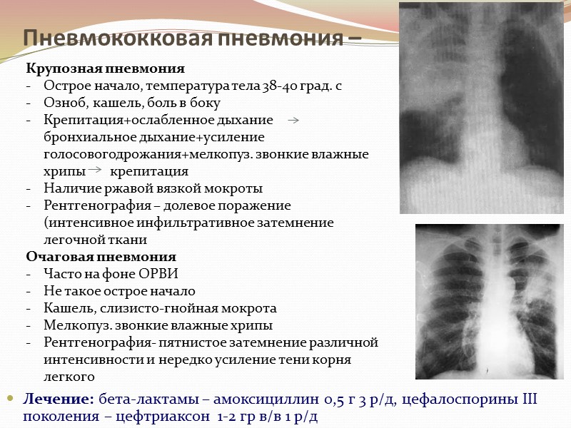 Пневмококковая пневмония –  Лечение: бета-лактамы – амоксициллин 0,5 г 3 р/д, цефалоспорины III